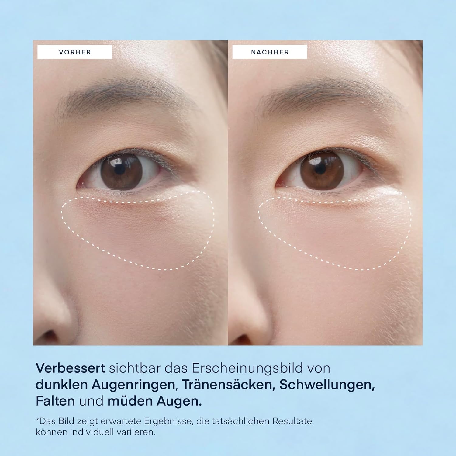 Augenpads Gegen Augenringe Korean Skincare: Hyaluron & Koffein Augenpads Gegen Tränensäcke & Falten - Vegan & Tierversuchsfrei, Für Empfindliche Haut Geeignet Augenmaske, 30 Paare - under Eye Patches