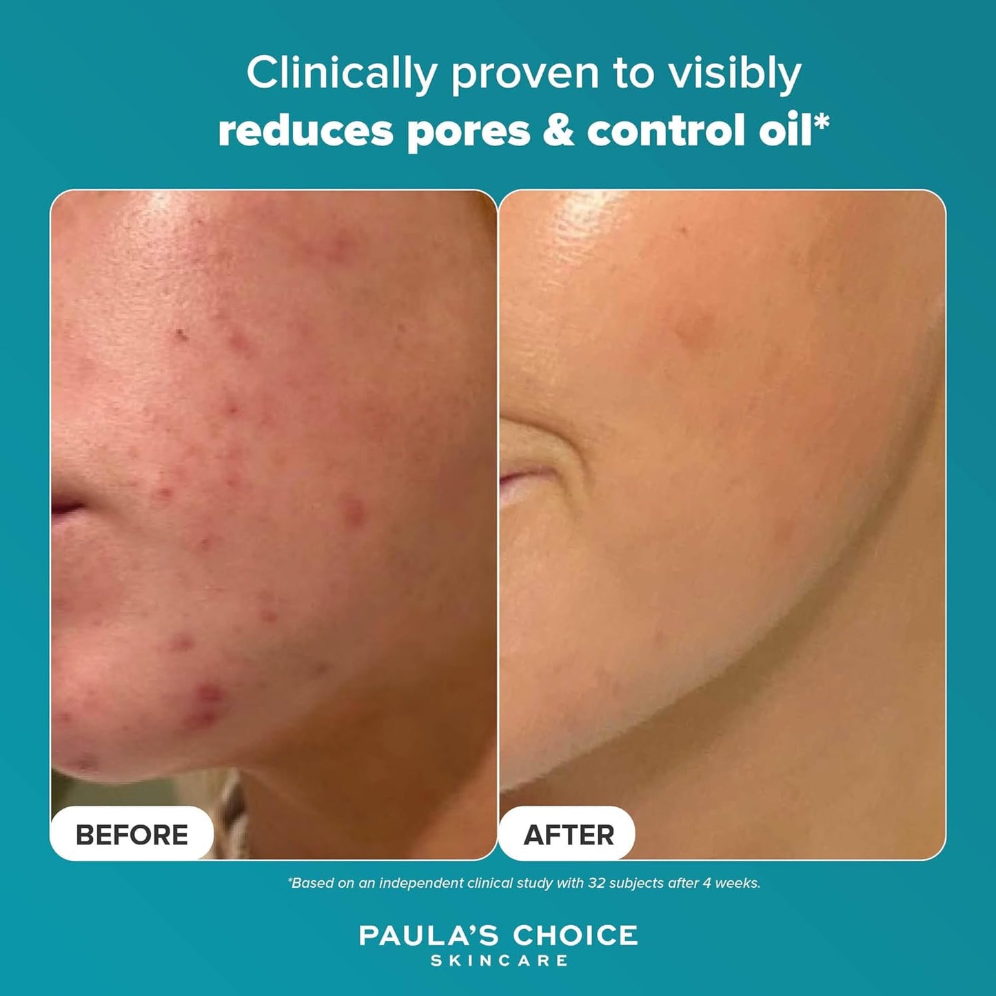 Paula'S Choice SKIN PERFECTING 2% BHA Liquid Peeling - Gesichtspeeling Mit Salicylsäure - Bekämpft Unreine Haut & Mitesser - Verkleinert Poren Sichtbar - Mischhaut, Fettige & Akne Haut - 30 Ml